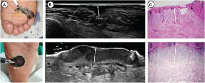 The utility of high-frequency 18 MHz ultrasonography for preoperative evaluation of acral melanoma thickness in Chinese patients